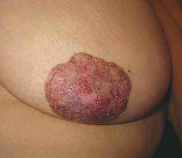 MAMMARY PAGET'S DISEASE