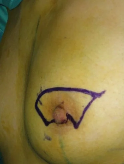 PREOPERATIVE EXCISION DRAWING