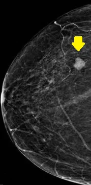 MEDULLARY BREAST CARCINOMA 