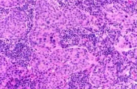 MEDULLARY BREAST CARCINOMA 