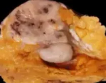 METAPLASTIC BREAST CARCINOMA