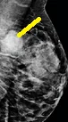 METAPLASTIC BREAST CARCINOMA