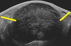 METASTATIC BREAST TUMOR - UTERINE LEIOMYOSARCOMA