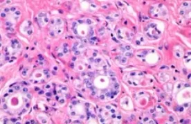 MICROGLANDULAR ADENOSIS
