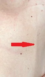 MONDOR'S DISEASE