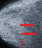 MONDOR'S DISEASE