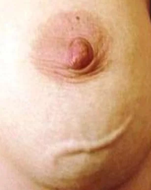 MONDOR'S DISEASE