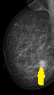 MUCINOUS CARCINOMA