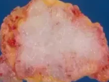 MUCINOUS BREAST CARCINOMA