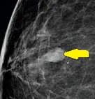 NEUROENDOCRINE BREAST CARCINOMA
