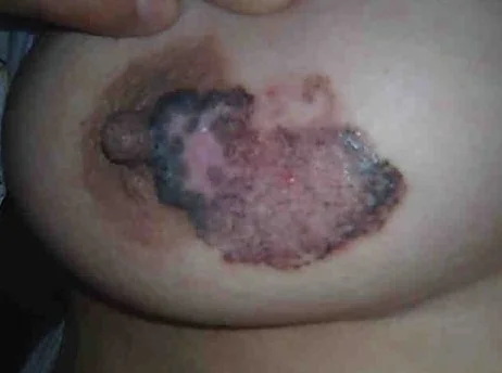 NIPPLE BASAL CELL CARCINOMA