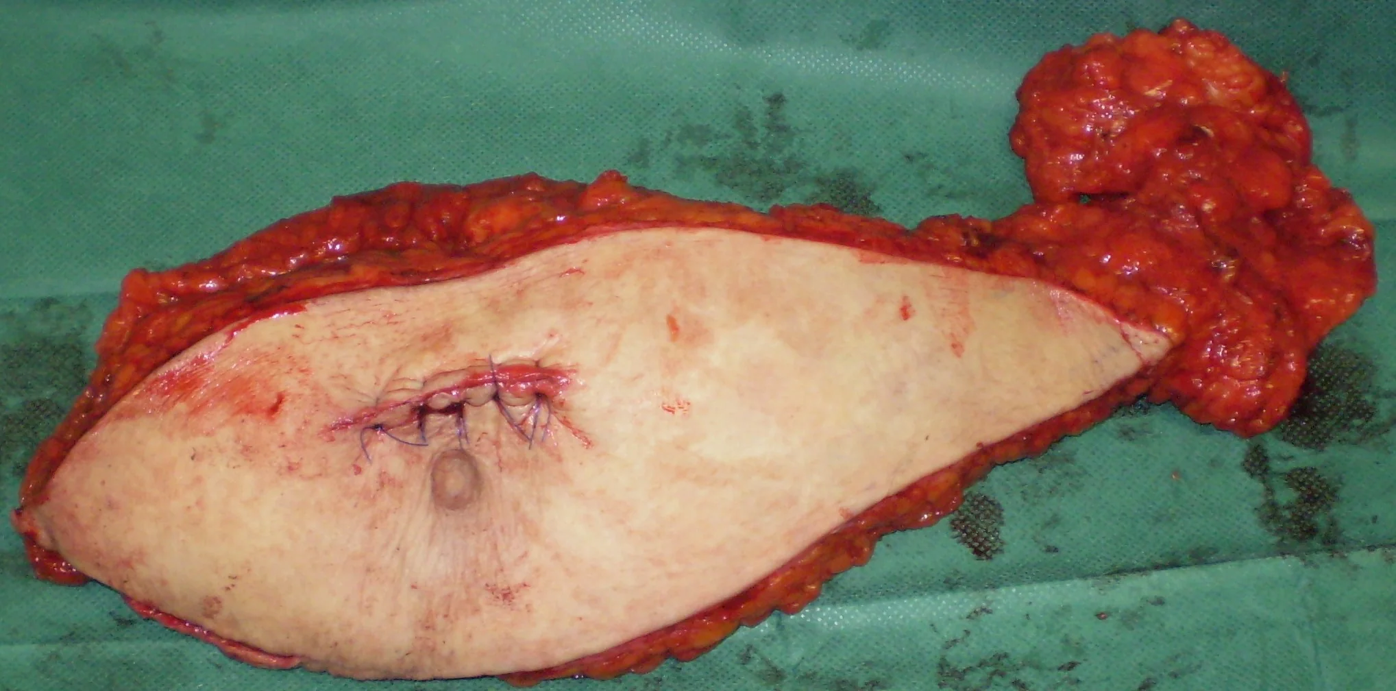 POST FROZEN SECTION - SIMPLE MASTECTOMY