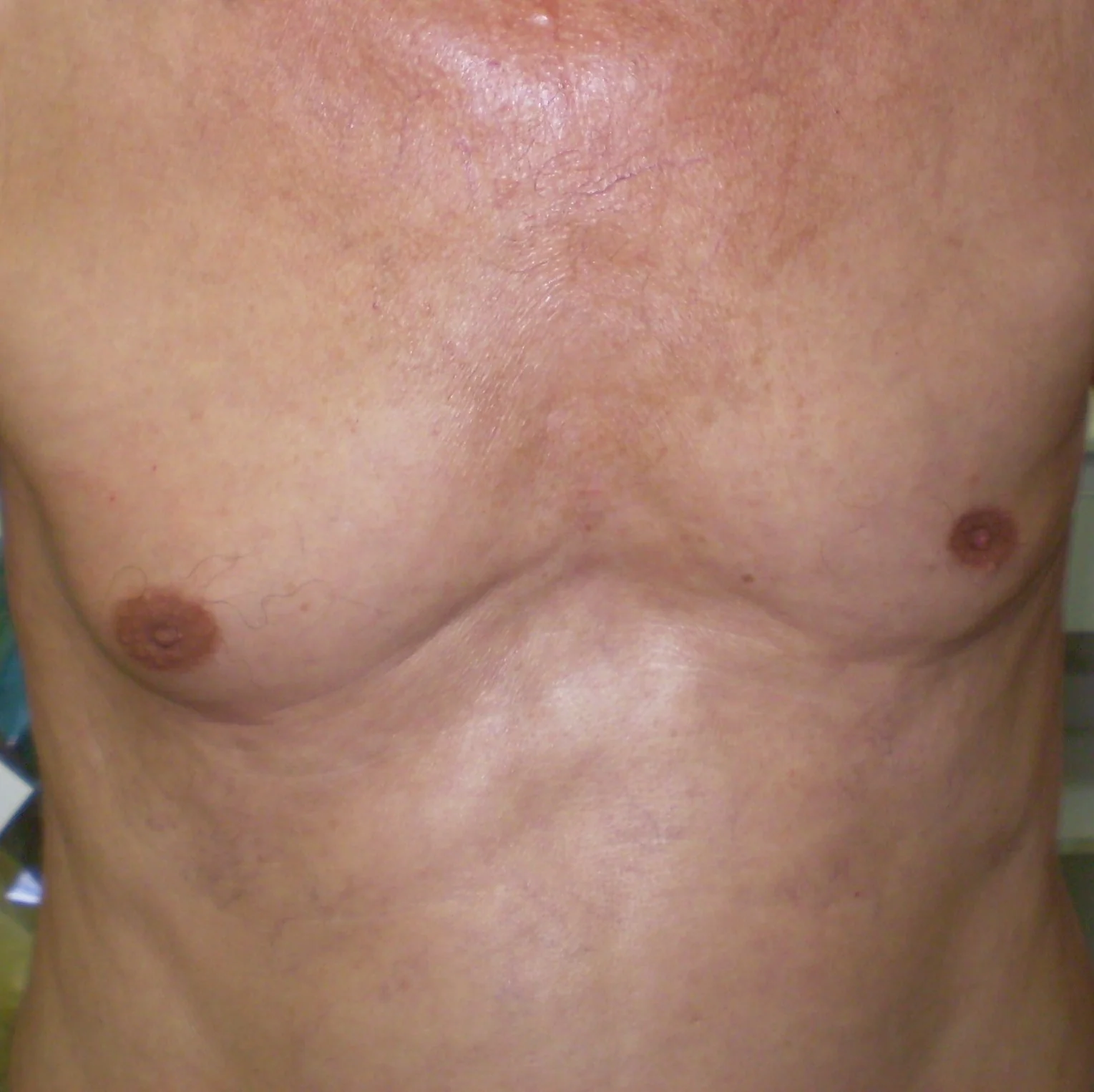 GYNECOMASTIA