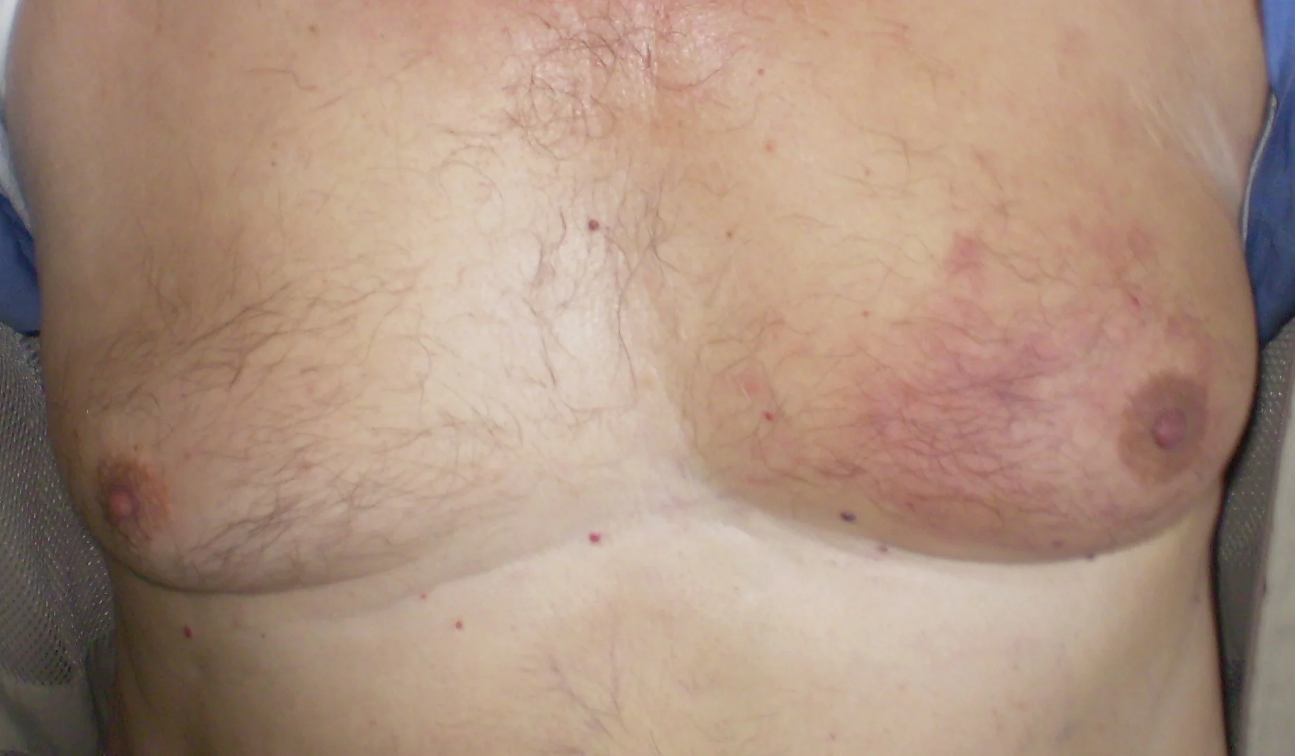 GYNECOMASTIA