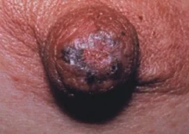 MAMMARY PAGET'S DISEASE