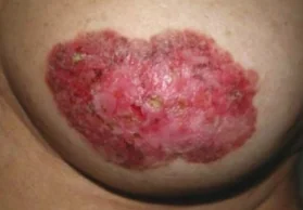MAMMARY PAGET'S DISEASE