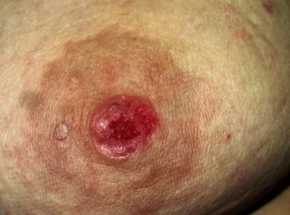 MAMMARY PAGET'S DISEASE