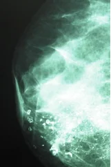 MAMMARY PAGET'S DISEASE