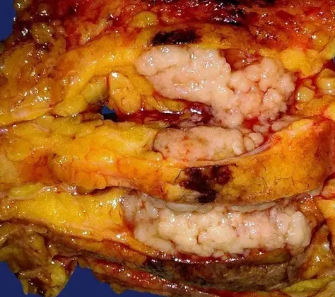 PAPILLARY BREAST CARCINOMA