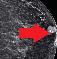 PAPILLARY DUCT TUMOR