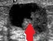 PAPILLARY DUCT TUMOR