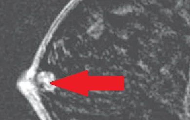 PAPILLARY DUCT TUMOR