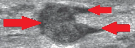 PAPILLARY DUCT TUMOR