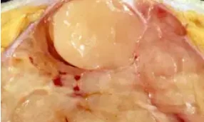 PHYLLODES BREAST TUMOR 
