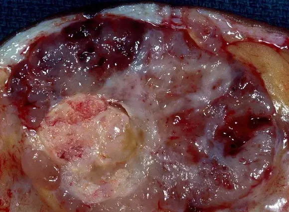 PHYLLODES BREAST TUMOR