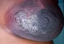 PLASMA CELL MASTITIS