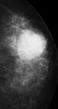PLASMACYTOMA