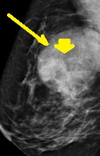 PSEUDOANGIOMATOUS STROMAL BREAST HYPERPLASIA
