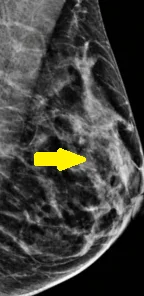 SCLEROSING BREAST ADENOSIS