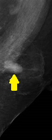SIGNET RING CELL BREAST CARCINOMA