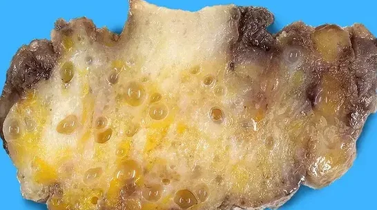 SILICON MASTITIS