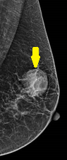 SOLID PAPILLARY BREAST CARCINOMA