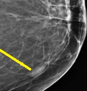 BREAST STROMAL FIBROSIS