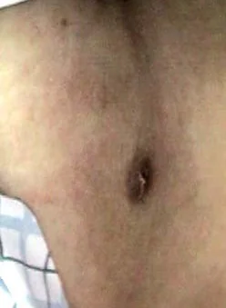SUPERNUMERARY NIPPLE