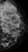 T - CELL LYMPHOBLASTIC LEUKEMIC DEPOSITS 