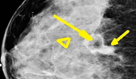 TUBULAR BREAST ADENOMA