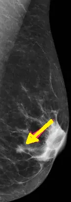 TUBULAR BREAST CARCINOMA