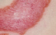 CUTANEOUS TUBERCULOSIS