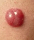 PIGMENTED AMELANOTIC MELANOMA