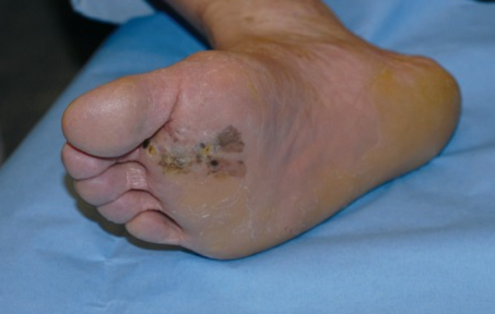 FOOT MELANOMA