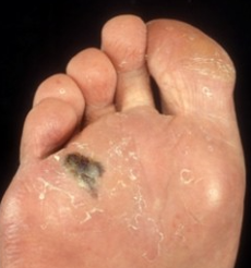 FOOT MELANOMA