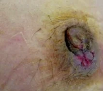 NIPPLE DERMATOSIS