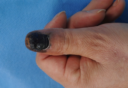 FINGER MELANOMA