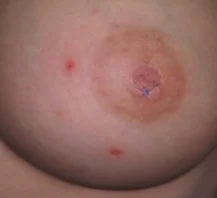 NIPPLE DERMATOSIS