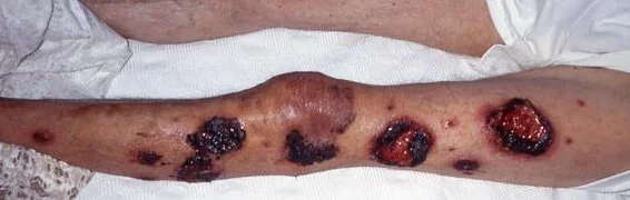 ECTHYMA