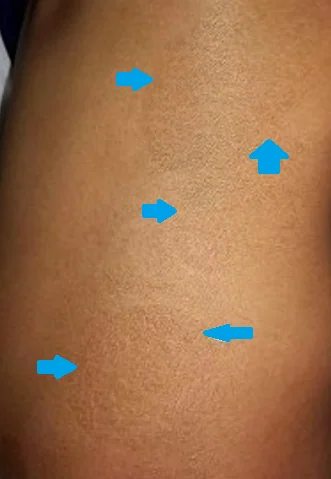PITYRIASIS ROTUNDA